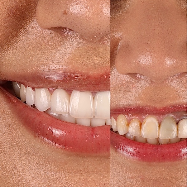 Veneers in Houston, TX
